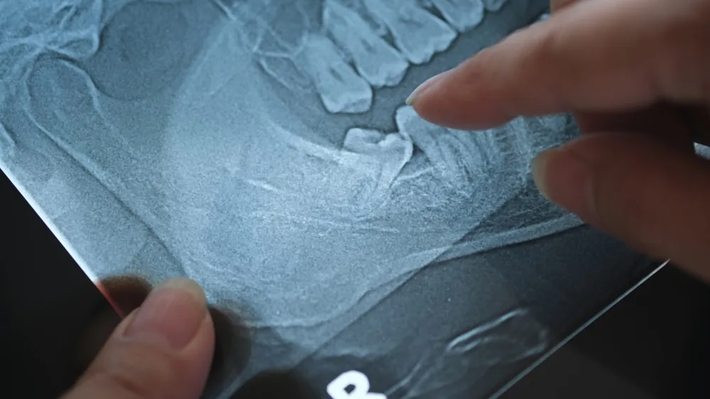 Finger pointing to an impacted lower wisdom tooth on a dental X-ray